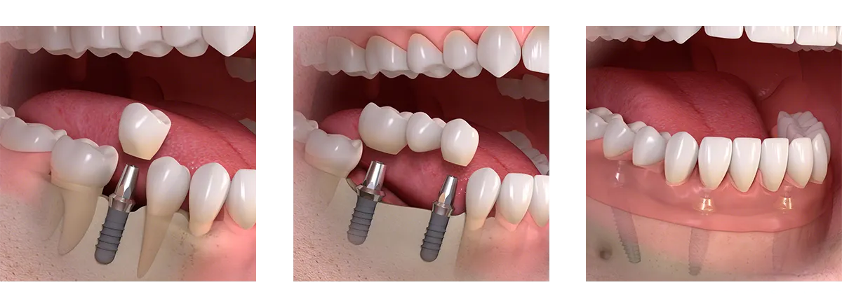 Möglichkeiten von Zahnimplantaten und Zahnersatz